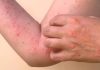 PELOTAS REGISTRA PRIMEIRO CASO DE CHIKUNGUNYA