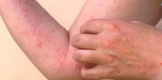 PELOTAS REGISTRA PRIMEIRO CASO DE CHIKUNGUNYA